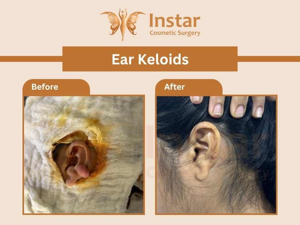Ear Keloids-2